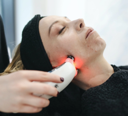 What are the Benefits of Laser Treatment for Acne Scars?